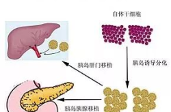 干细胞 糖尿病,革新疗法与未来展望