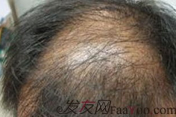 脂溢性脱发治疗偏方,中医古法与现代生活的完美融合”